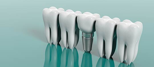 Dental implant procedure for tooth replacement, services in Portland OR and Vancouver WA