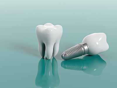 mini dental implants and mdi in Portland OR and Vancouver WA