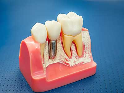 single tooth dental implant service in Portland OR and Vancouver WA