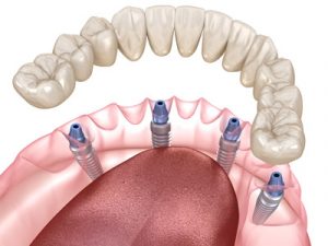 A digital rendition of all-on-4 dental implants showing where the titanium screws are placed.