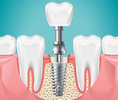a rendering of a dental implant that's securely in place