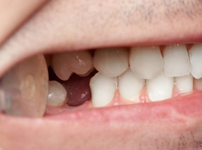 gum disease can cause tooth loss like this patient's