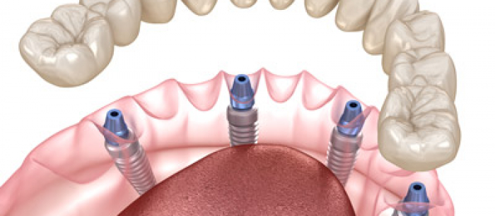 A digital rendition of all-on-4 dental implants. Swiss Denture & Implant Center provides all-on-4 dental implants for patients in Portland OR